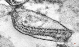 M, 71y. | melanoblastoma - promelanosome M, 71y. | melanoblastoma - promelanosome